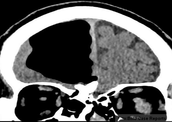 mozak sa vazdusnim dzepom (slika druga) mozak sa vazdusnim dzepom (slika druga)