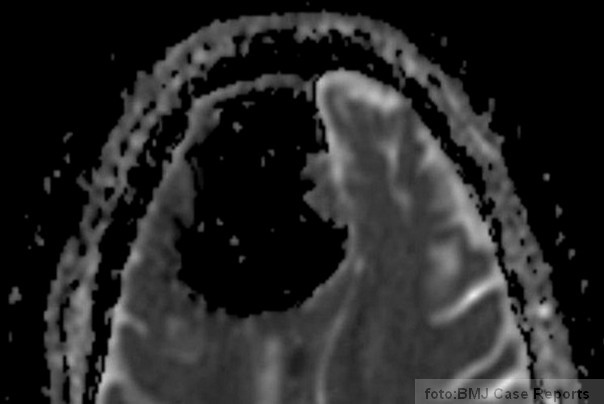 mozak sa vazdusnim dzepom