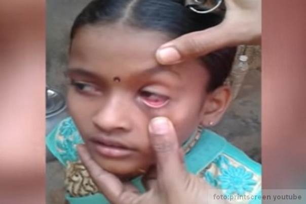 mravi joj izlaze na oci