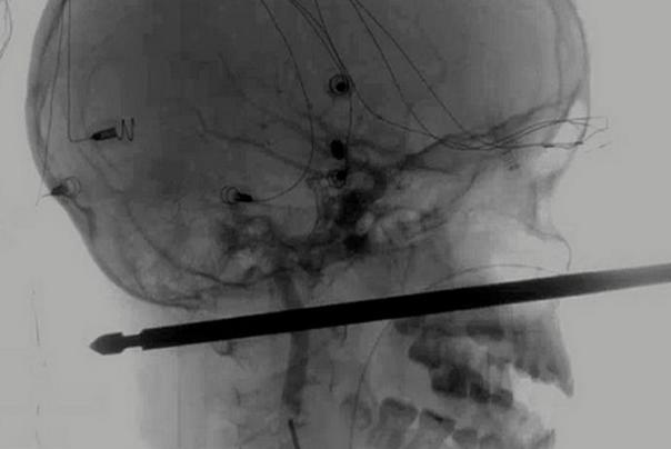 ražanj u lobaji dečaka