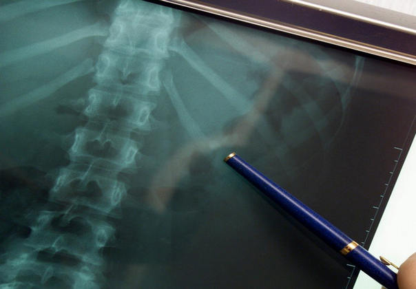 bubreg pelvični snimak