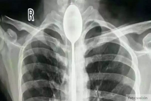 kašika zaglavljena u grlu kineza - regten kašika zaglavljena u grlu kineza - regten