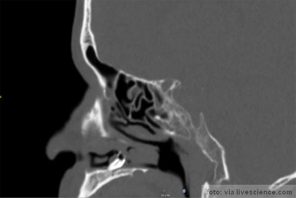zub u nosu CT snimak zub u nosu CT snimak FOTO:BMJ Case Reports