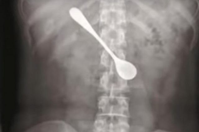 ka&scaron;ika progutana na retgentskom snimku