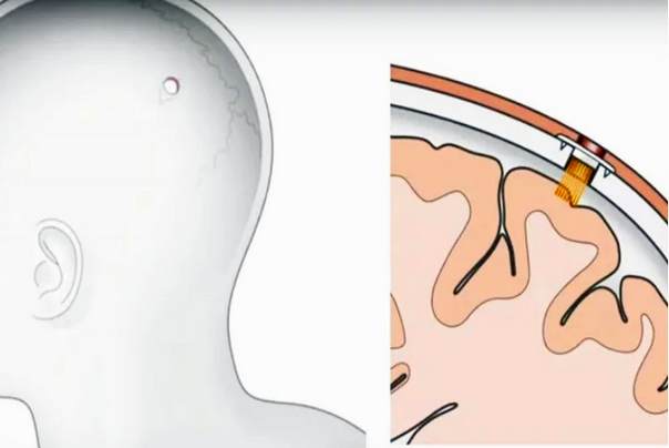 čip u mozgu Eleon Musk neuralink