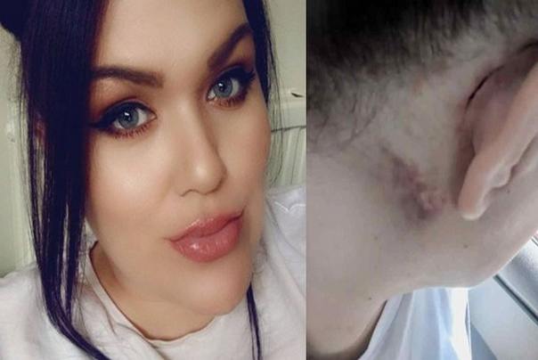 Woman Can Hear Her Own Blood Flowing and Eyeballs Moving rare medicene phenomen