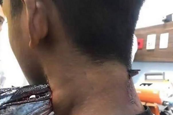 riba u vratu tinejdžera