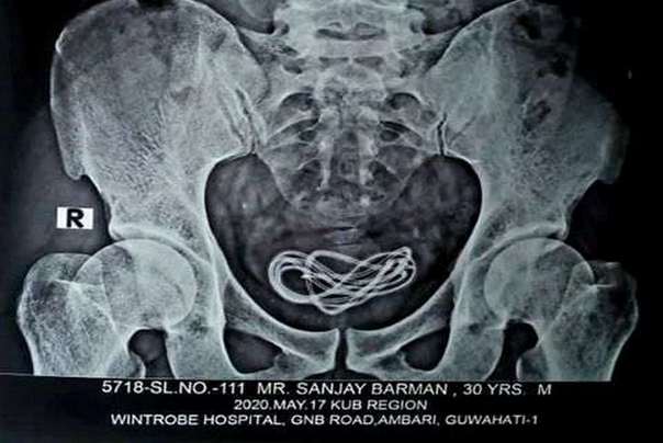 kabal punjac tel rentgenski snimak