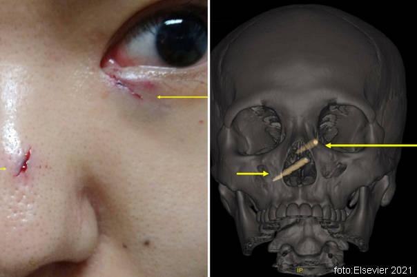 plastični &scaron;tapići u lobanji