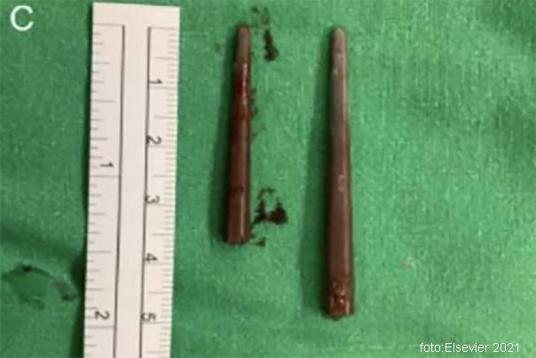 plastični &scaron;tapići izvučeni iz lobanje