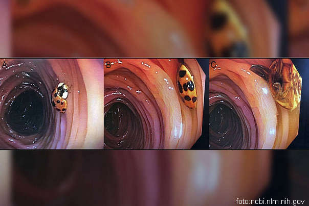 bubamara u debelom crevu