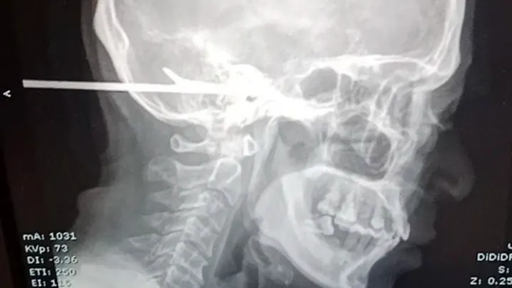 CT snimak hrapuna u glavi