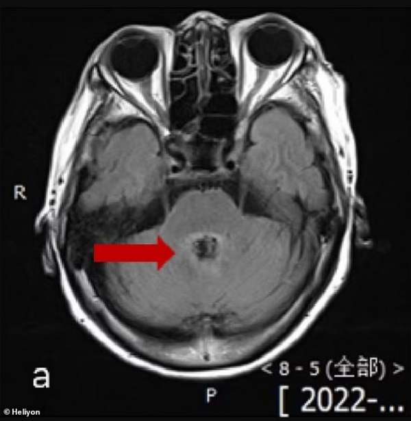 mozak žene sa parazitom 