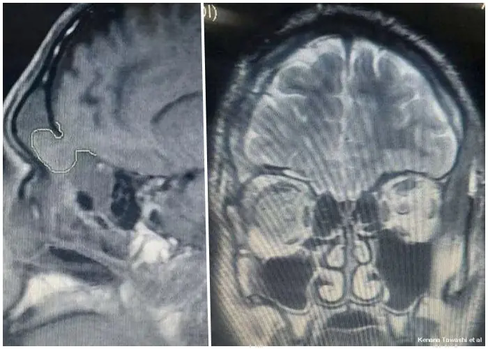 CT snimak curenje mozga