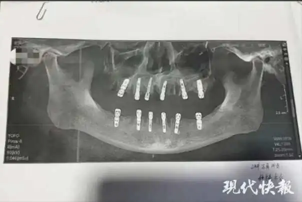 Sken zuba preminulog pacijenta