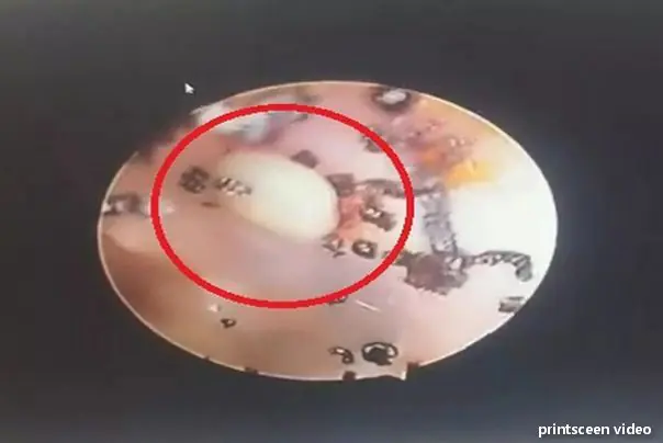 krpelji u uhu devojčice