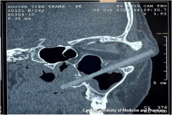&scaron;tapić u glavi pacineta rendgenski snimak