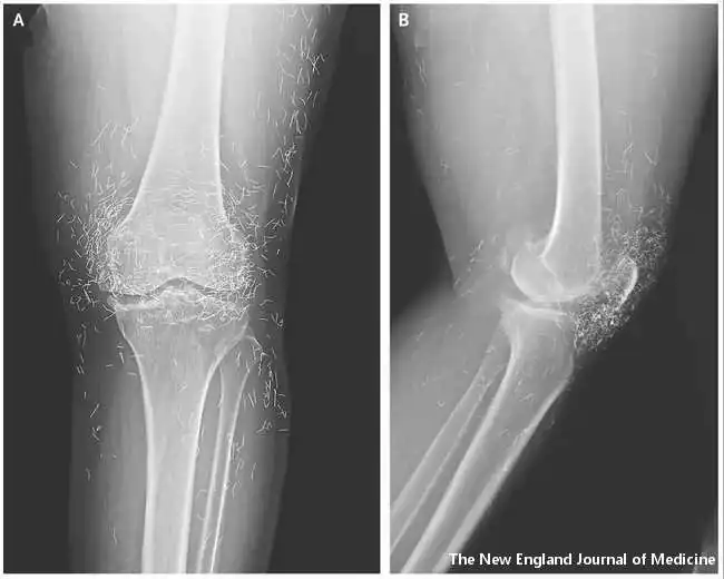 zlatne niti u kolenu