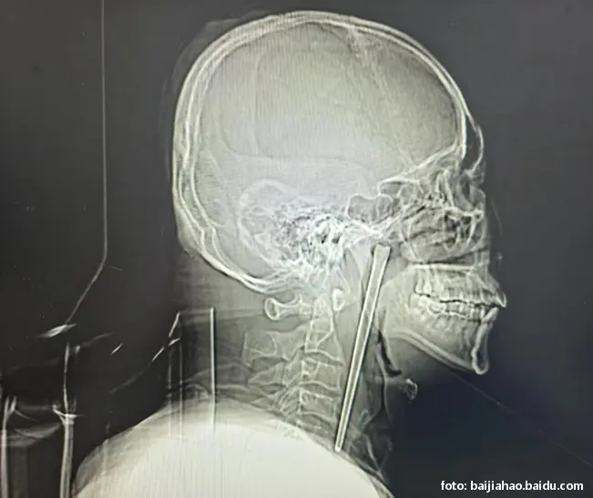 metalni štapić grlo