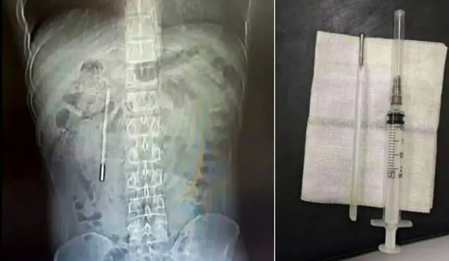 rendgenski snimak toplomera iz tela